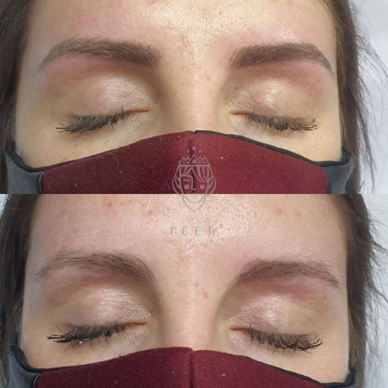 Pigmentation